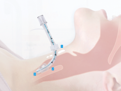 Konikotomia chirurgiczna