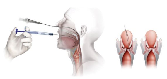 Augmentacja fałdów głosowych